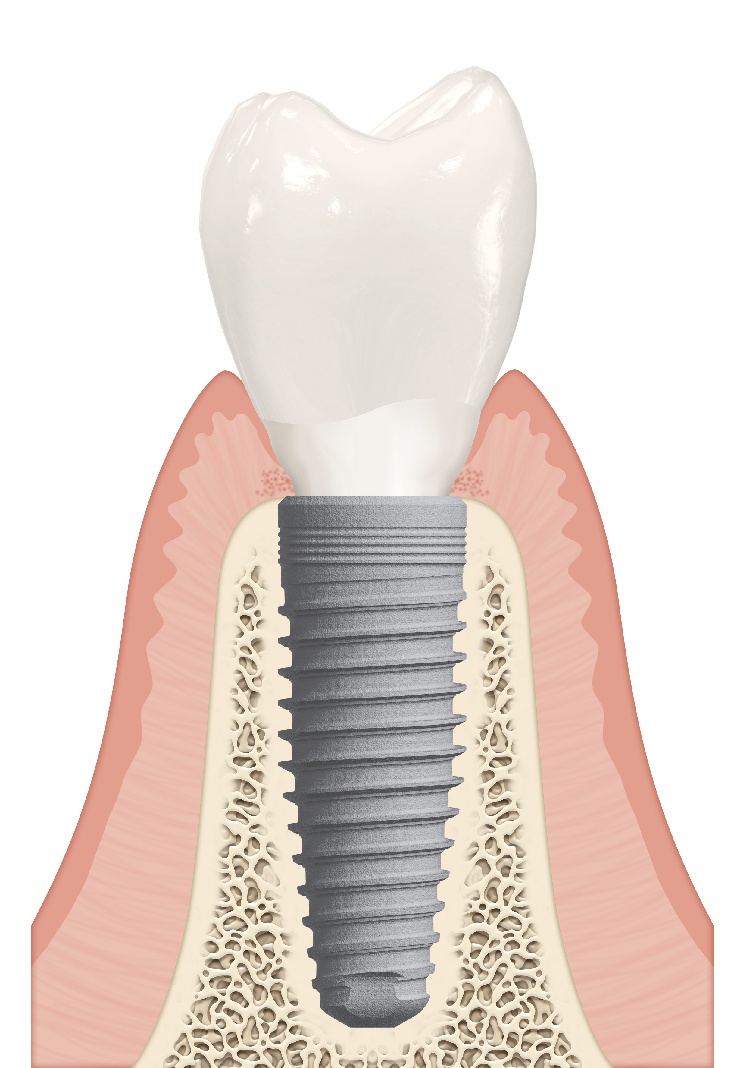 single implant